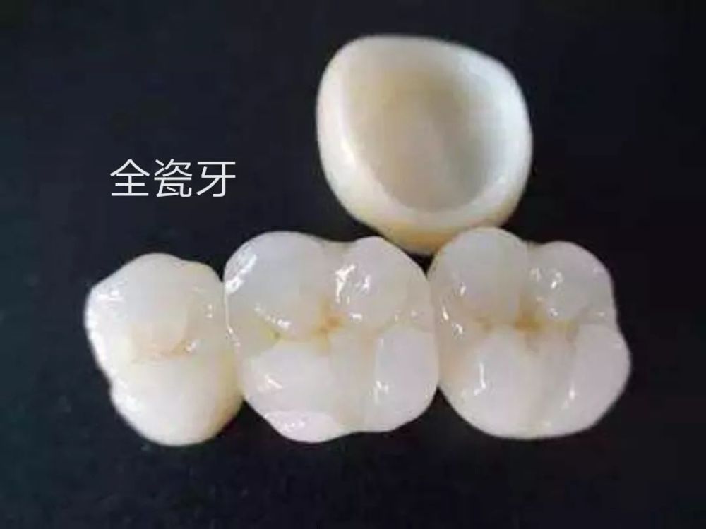 贵金属全瓷牙(全瓷牙和金属牙有什么区别)
